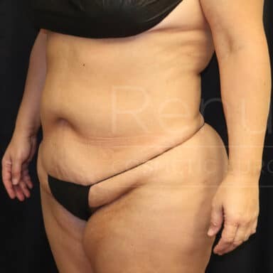Procedure before and after - before