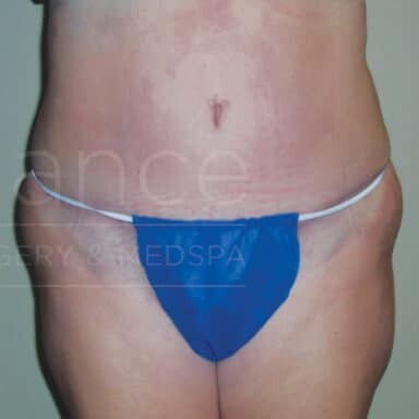Procedure before and after - after
