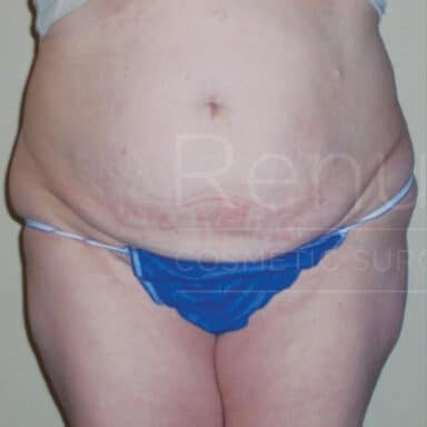 Procedure before and after - before