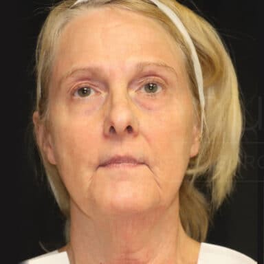 Procedure before and after - before