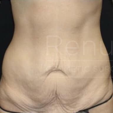 Procedure before and after - before