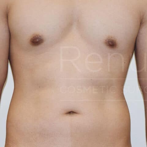 Vaser Liposuction before and after - before