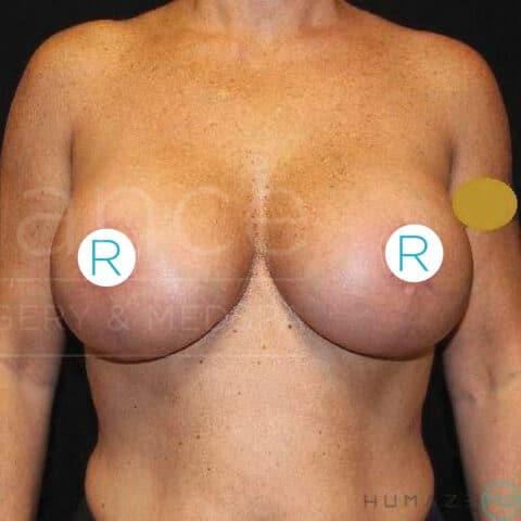 Breast Lift before and after - after