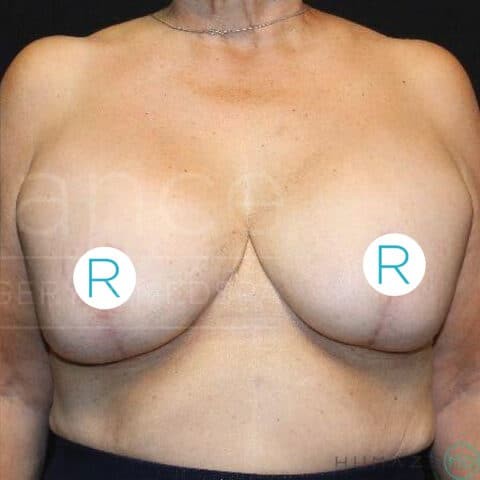 Breast Lift before and after - after