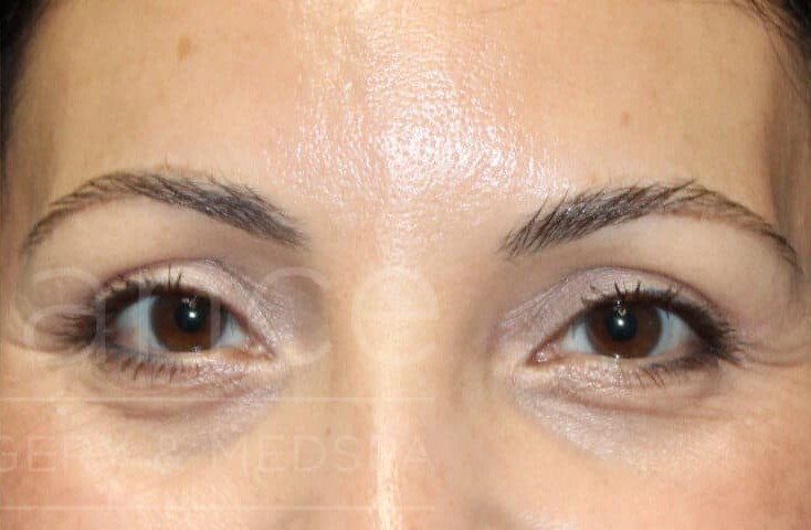 Blepharoplasty before and after - after