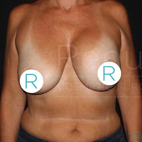 Breast Lift before and after - before