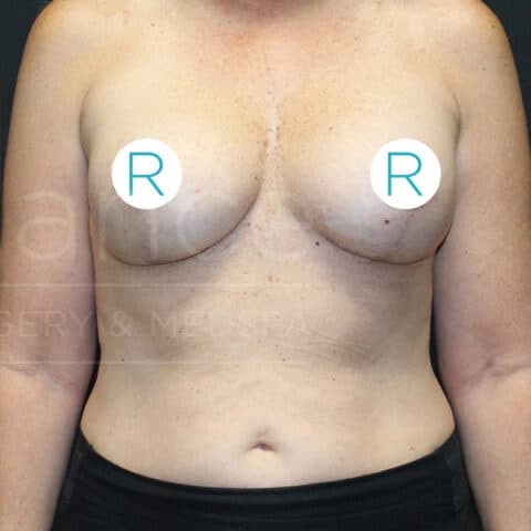 Breast Lift before and after - after