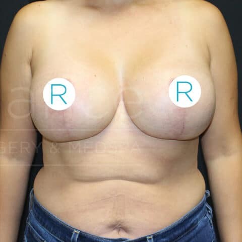 Breast Lift before and after - after