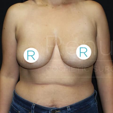 Breast Lift before and after - before