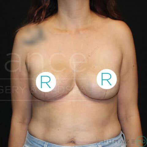 Breast Reduction before and after - after