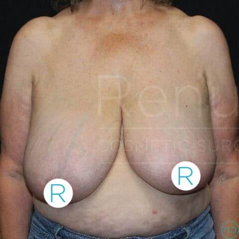 Breast Lift before and after - before
