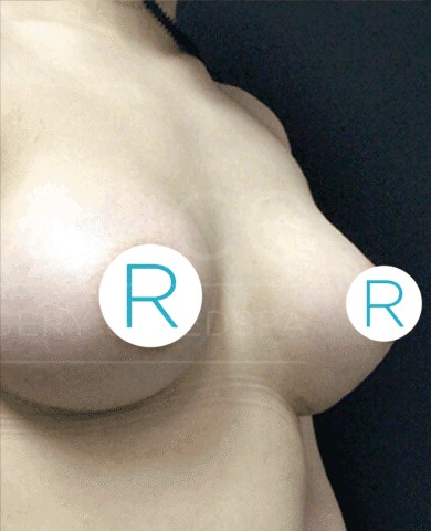 Breast Augmentation before and after - after