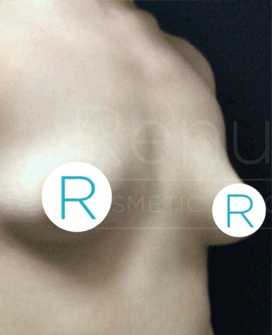 Breast Augmentation before and after - before