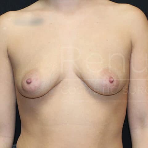 Breast Augmentation before and after - before