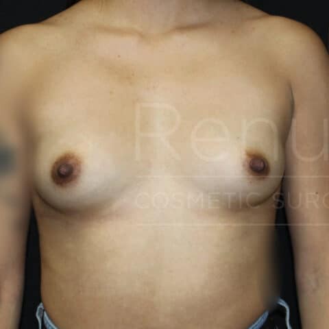 Breast Augmentation before and after - before