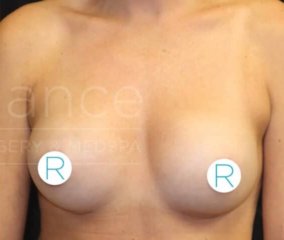 Breast Augmentation before and after - after