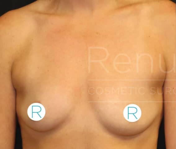 Breast Augmentation before and after - before