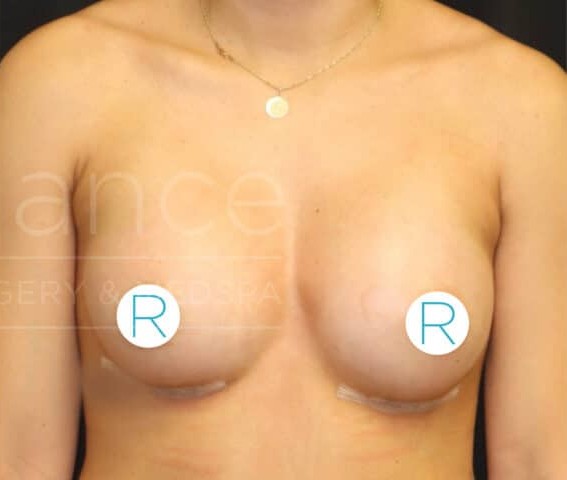 Breast Augmentation before and after - after