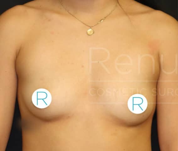 Breast Augmentation before and after - before