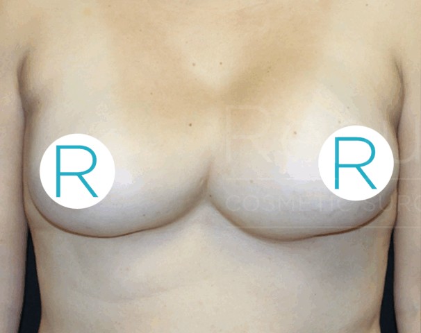 Breast Implant Revision before — Dr. Chinwe Kpaduwa