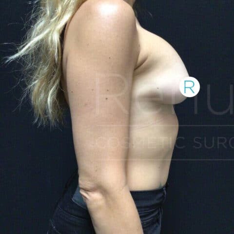 Breast Implant Revision before — Dr. Chinwe Kpaduwa