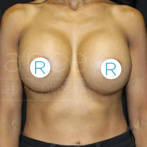 Breast Implant Revision after — Dr. Chinwe Kpaduwa