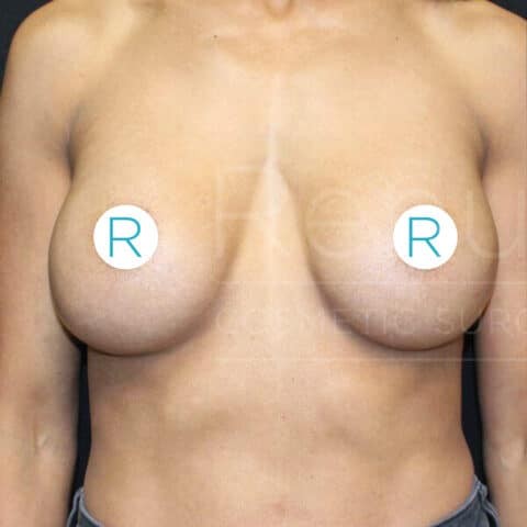 Breast Implant Revision before — Dr. Chinwe Kpaduwa