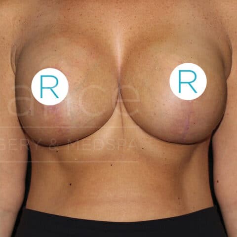 Breast Implant Revision after — Dr. Chinwe Kpaduwa