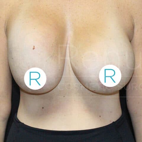 Breast Implant Revision before — Dr. Chinwe Kpaduwa