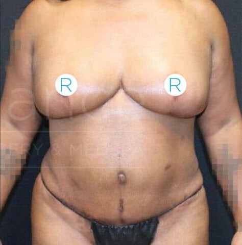 Breast Reduction before and after - after