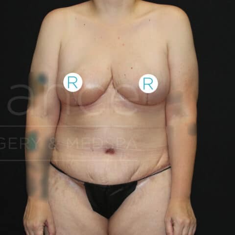 Breast Reduction before and after - after