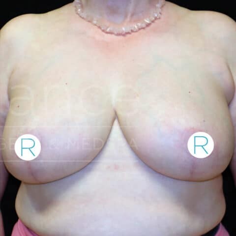 Breast Reduction before and after - after