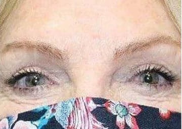 Blepharoplasty before and after - after