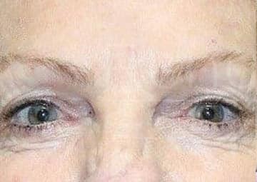 Blepharoplasty before and after - before