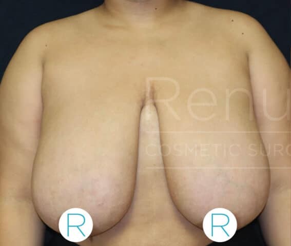 Breast Reduction before and after - before