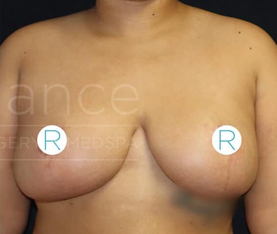 Breast Reduction before and after - after