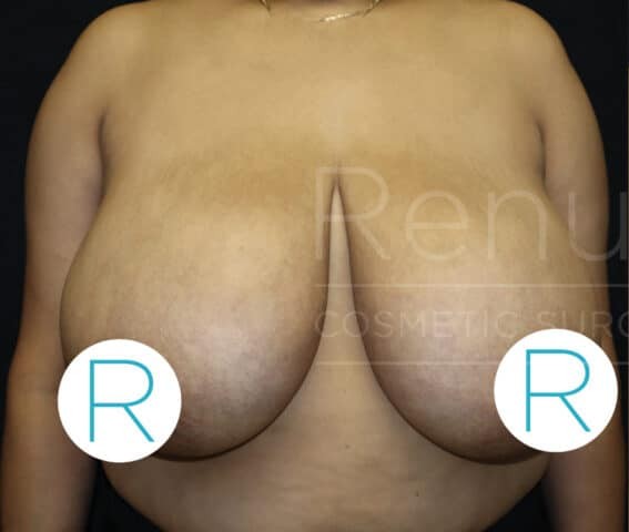Breast Reduction before and after - before