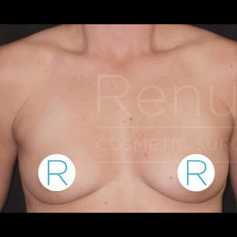 Breast Augmentation before and after - before