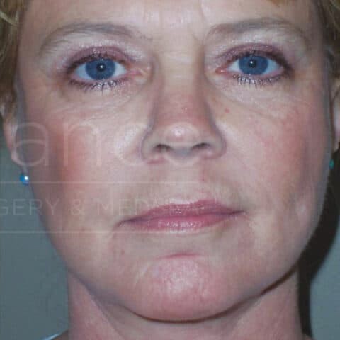 Facelift before and after - after