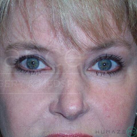 Blepharoplasty before and after - after