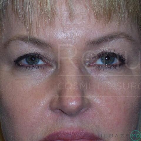 Blepharoplasty before and after - before