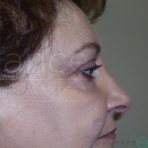 Blepharoplasty before and after - after