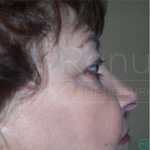 Blepharoplasty before and after - before