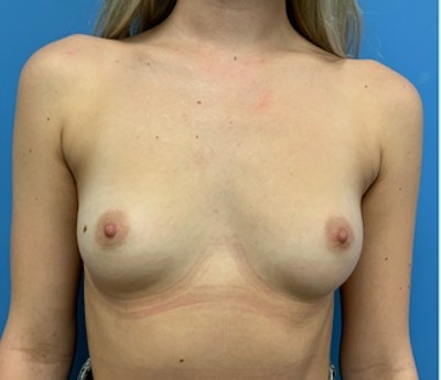 Breast Augmentation before and after - before