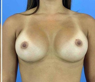 Breast Augmentation before and after - after