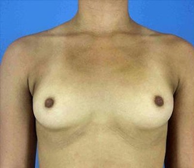 Breast Augmentation before and after - before