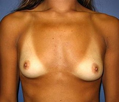 Breast Augmentation before and after - before