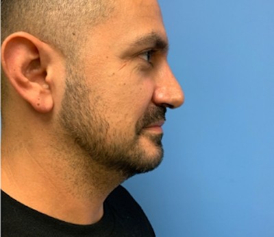 Rhinoplasty before and after - after