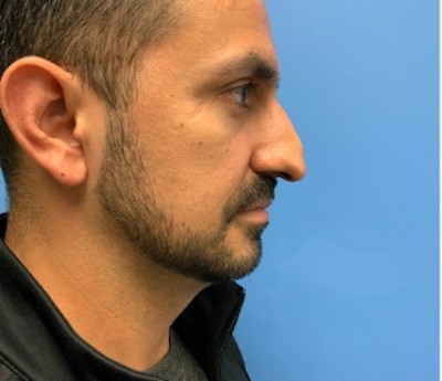 Rhinoplasty before and after - before