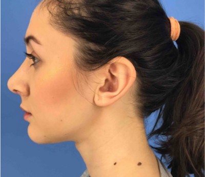 Rhinoplasty before and after - after